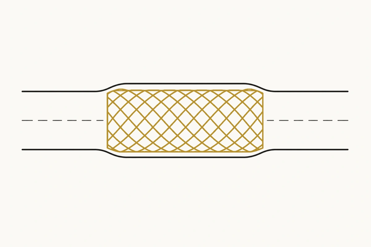 An expanded mesh stent seated inside a narrowed vessel, holding the lumen open.